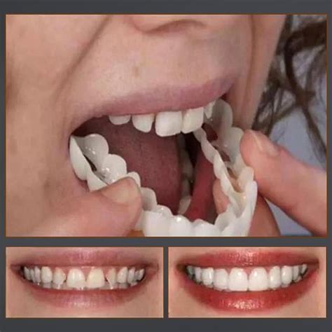 Improving Speech and Chewing Ability with Magic Smile Teeth Braces